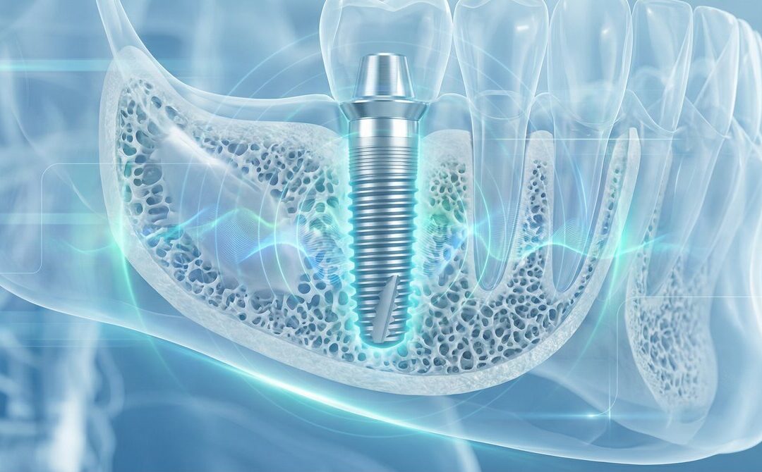 Your 'Healthy' Titanium Implant is an EMF Antenna: The Holistic Conspiracy They Don't Want You to Know